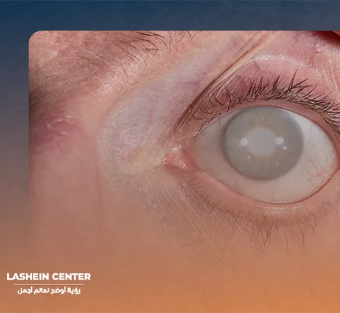 Treatment of cataracts in the eye
