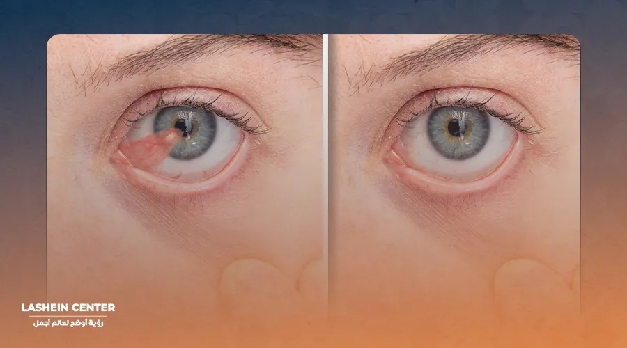 What is the difference between cataracts and glaucoma in the eye?