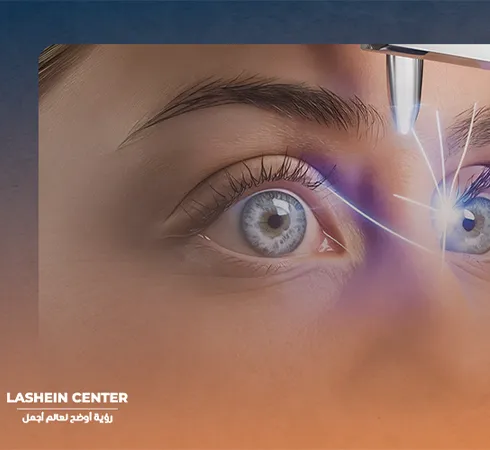 When does vision stabilize after LASIK surgery?