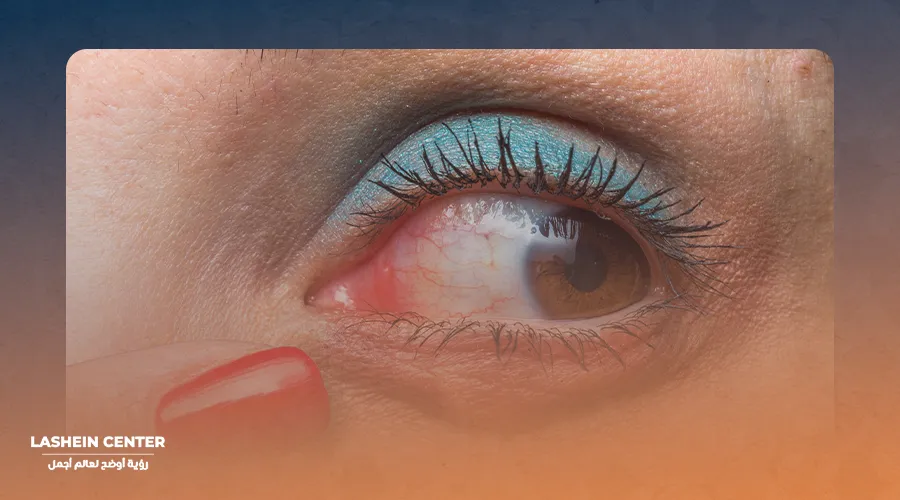 Treatment of ophthalmic vein occlusion