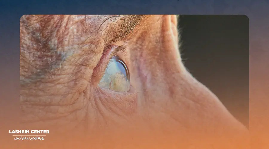 What is cataract surgery?