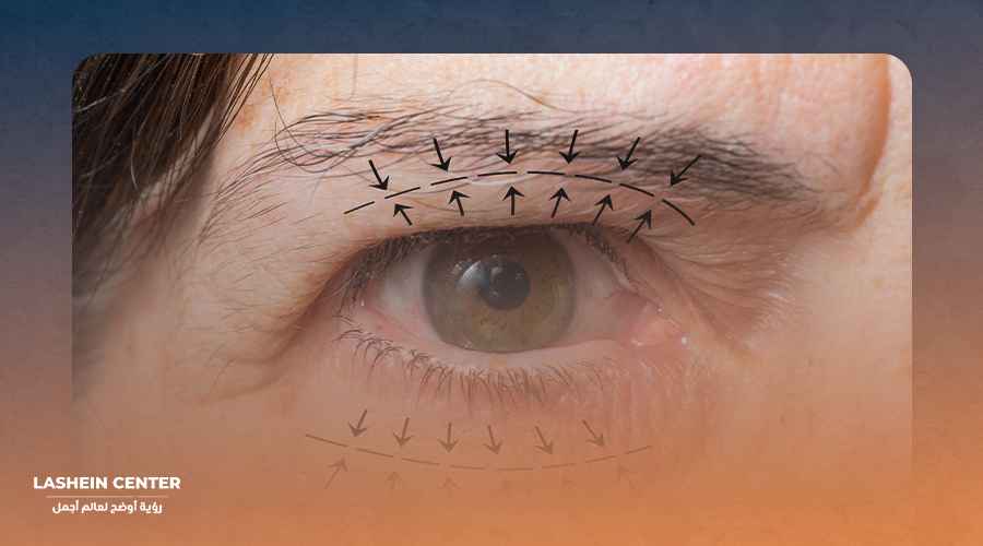 عمليات تجميل الجفون